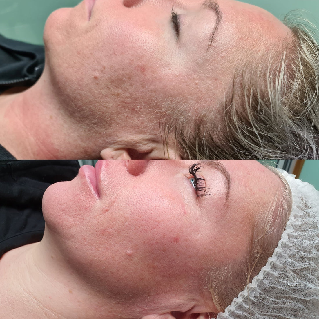 Understanding Rosacea: Why Redness Isn’t Just Skin Deep