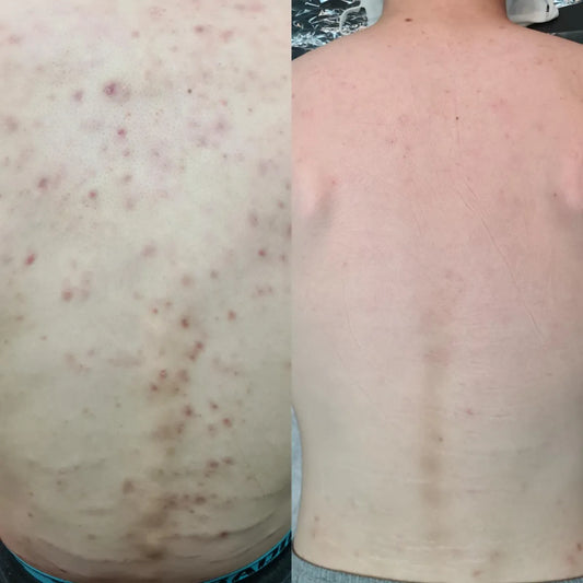 Why Acne Scarring Could Be the Hidden Culprit Behind Recurring Breakouts