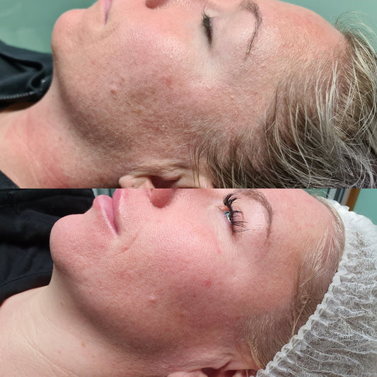 Understanding Rosacea: Why Redness Isn’t Just Skin Deep